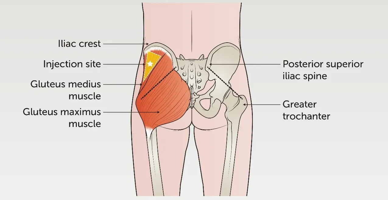 General Landmarks for Gluteal Injection Sites