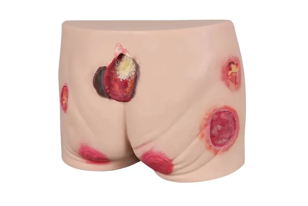 Buttock Pressure Ulcer Model