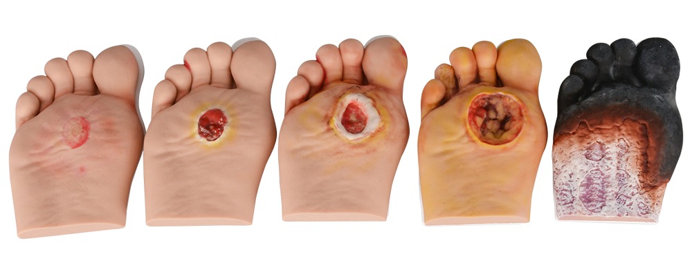 5-Stage Diabetic Foot Ulcer Model Set