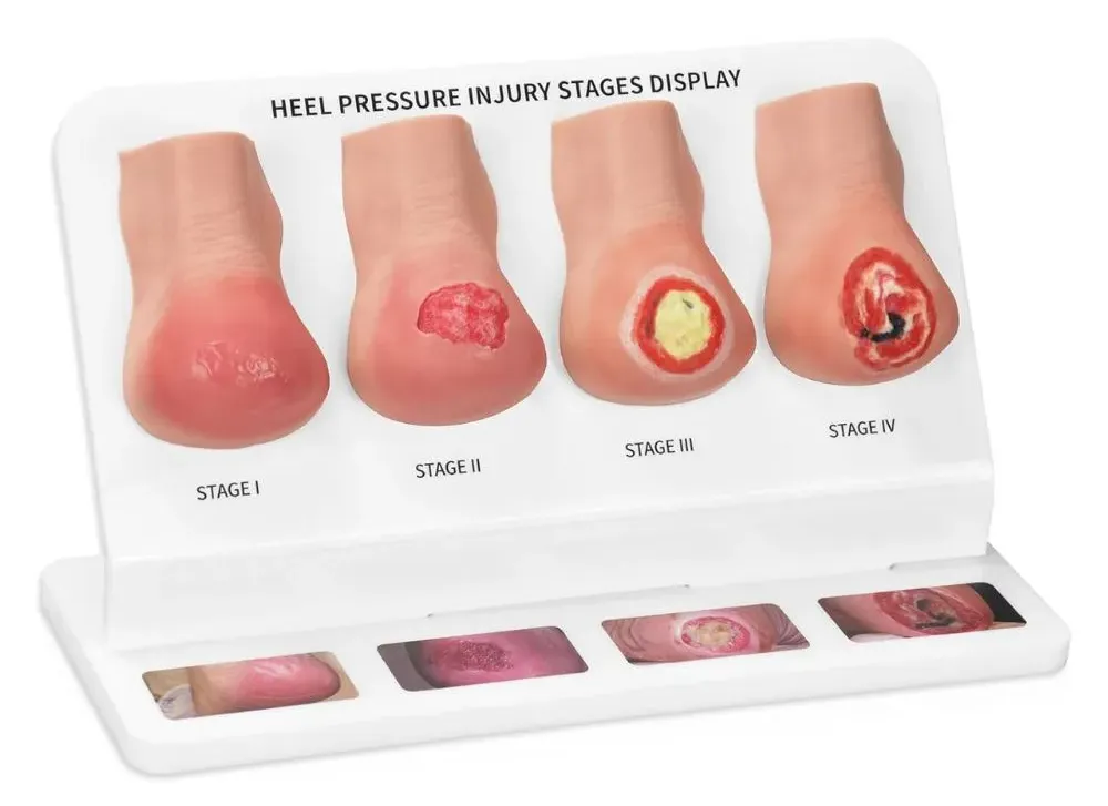Heel Pressure Injury Model