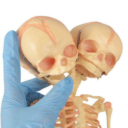 Infant Fetus Skeleton Model with Double Skull Head