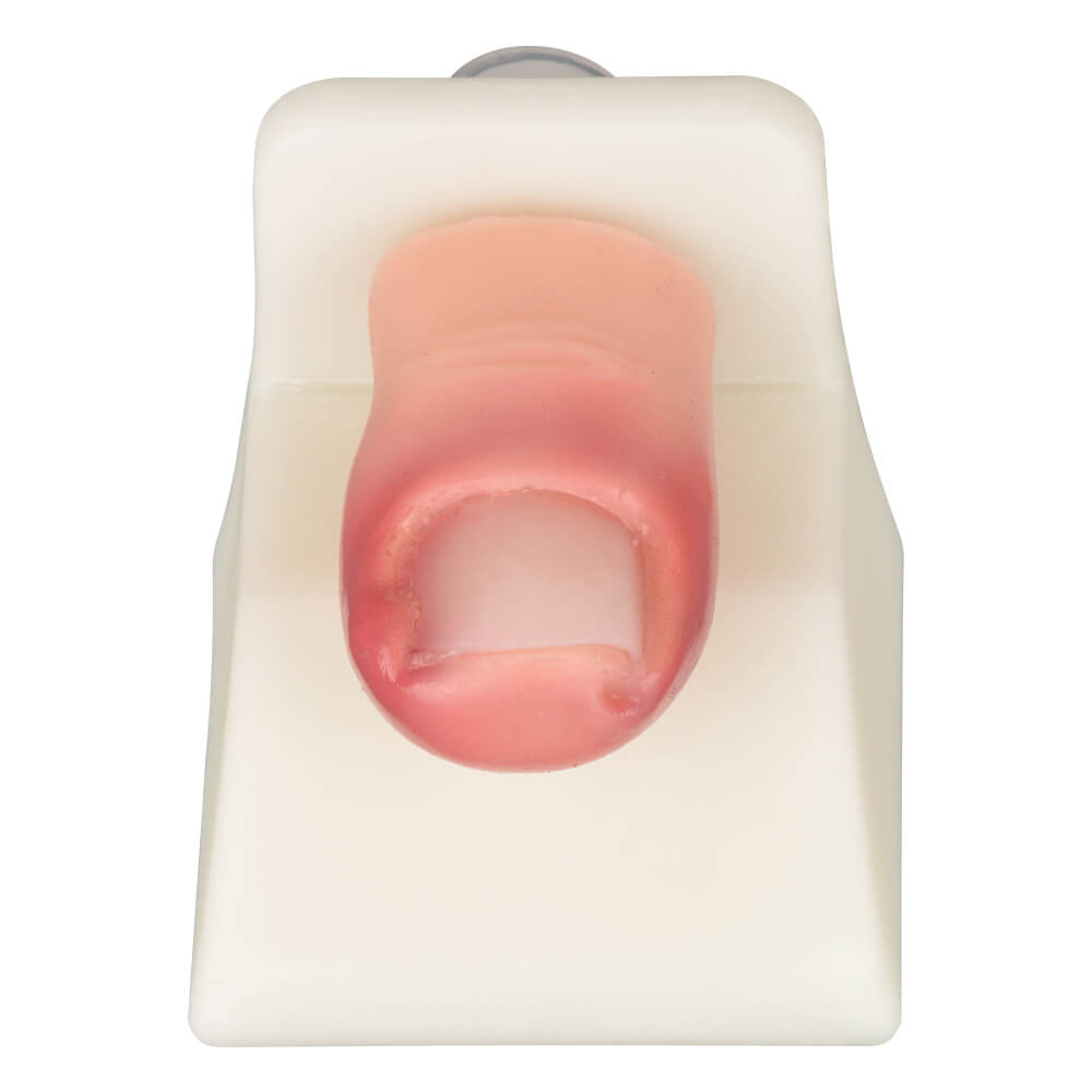 Ingrown Toenail Removal Trainer Model for Nail Avulsion Practice