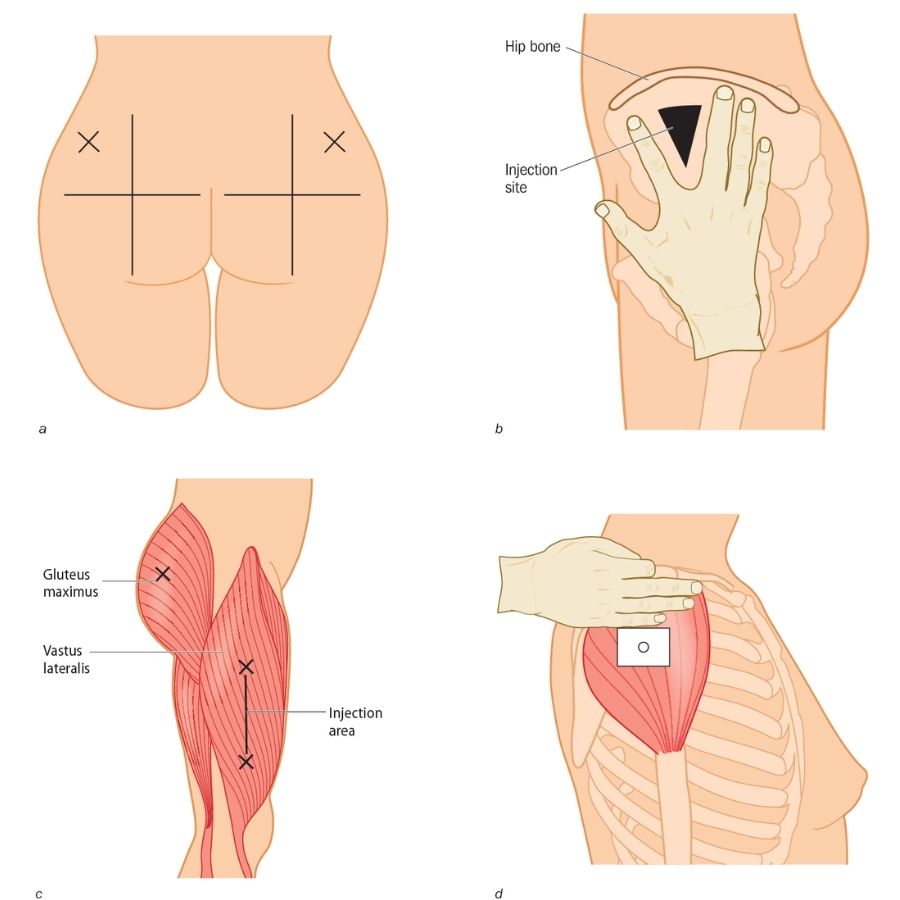 how to locate intramuscular injection sites