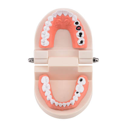 Life-Size Dental Caries Study Model with 28 Adult Teeth