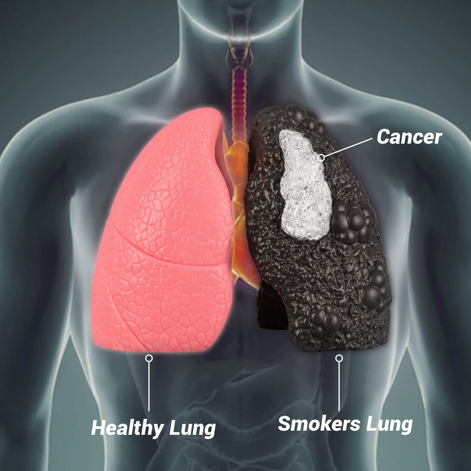 Ultrassist Healthy Lung vs. Smokers Lung Model Set
