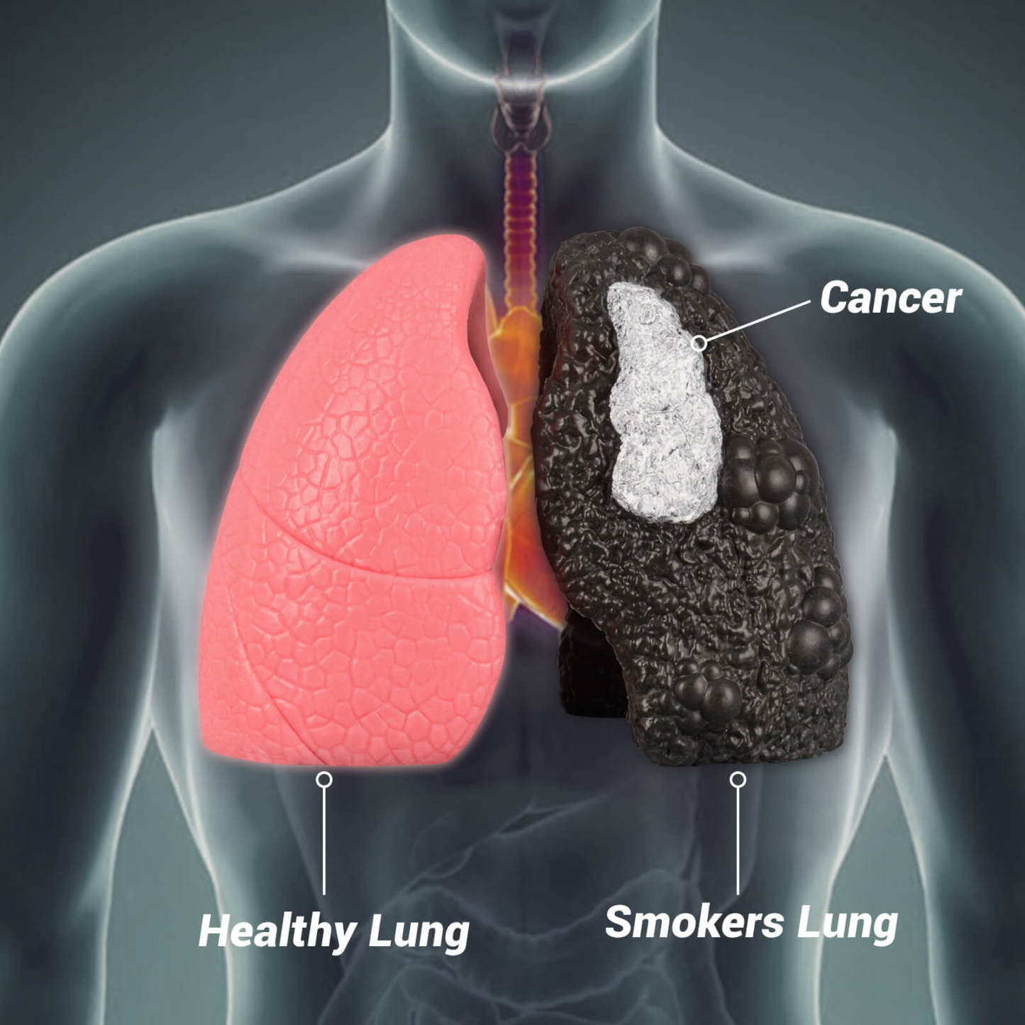 Ultrassist Healthy Lung vs. Smokers Lung Model Set