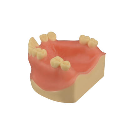 Maxillary Dental Implant Model Missing Partial Teeth 15, 21, 14