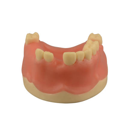 Maxillary Dental Implant Model Missing Partial Teeth 15, 21, 14