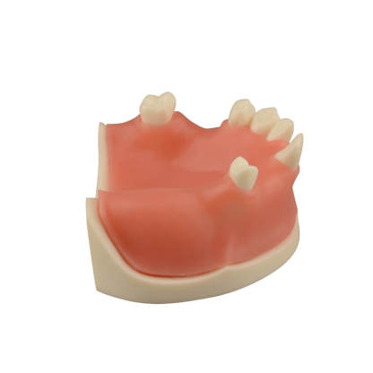 Maxillary Dental Implant Model with Practice Soft Gums, 1:1 Scale
