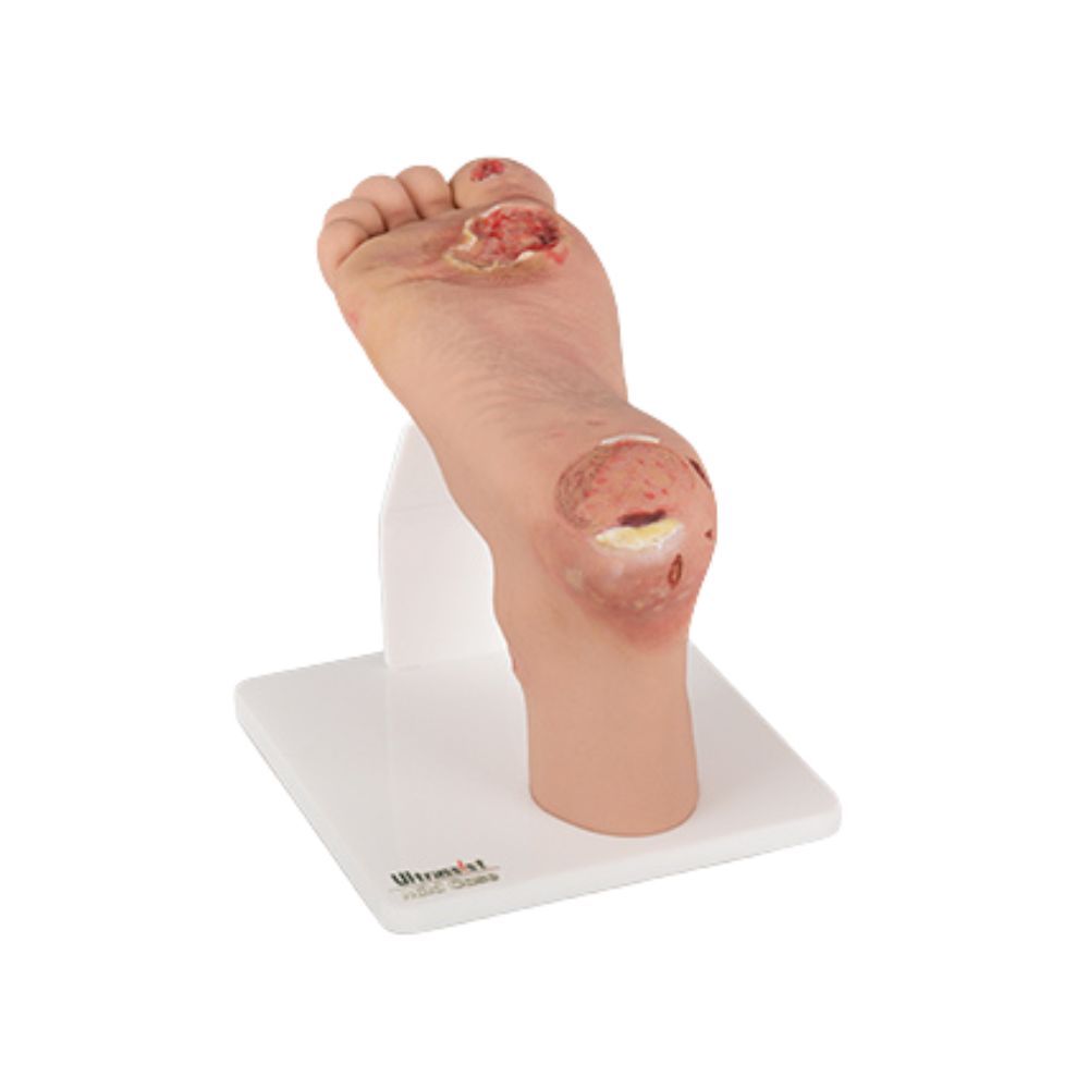 Full-Foot Diabetic Foot Ulcer Model - Mild & Severe Stages