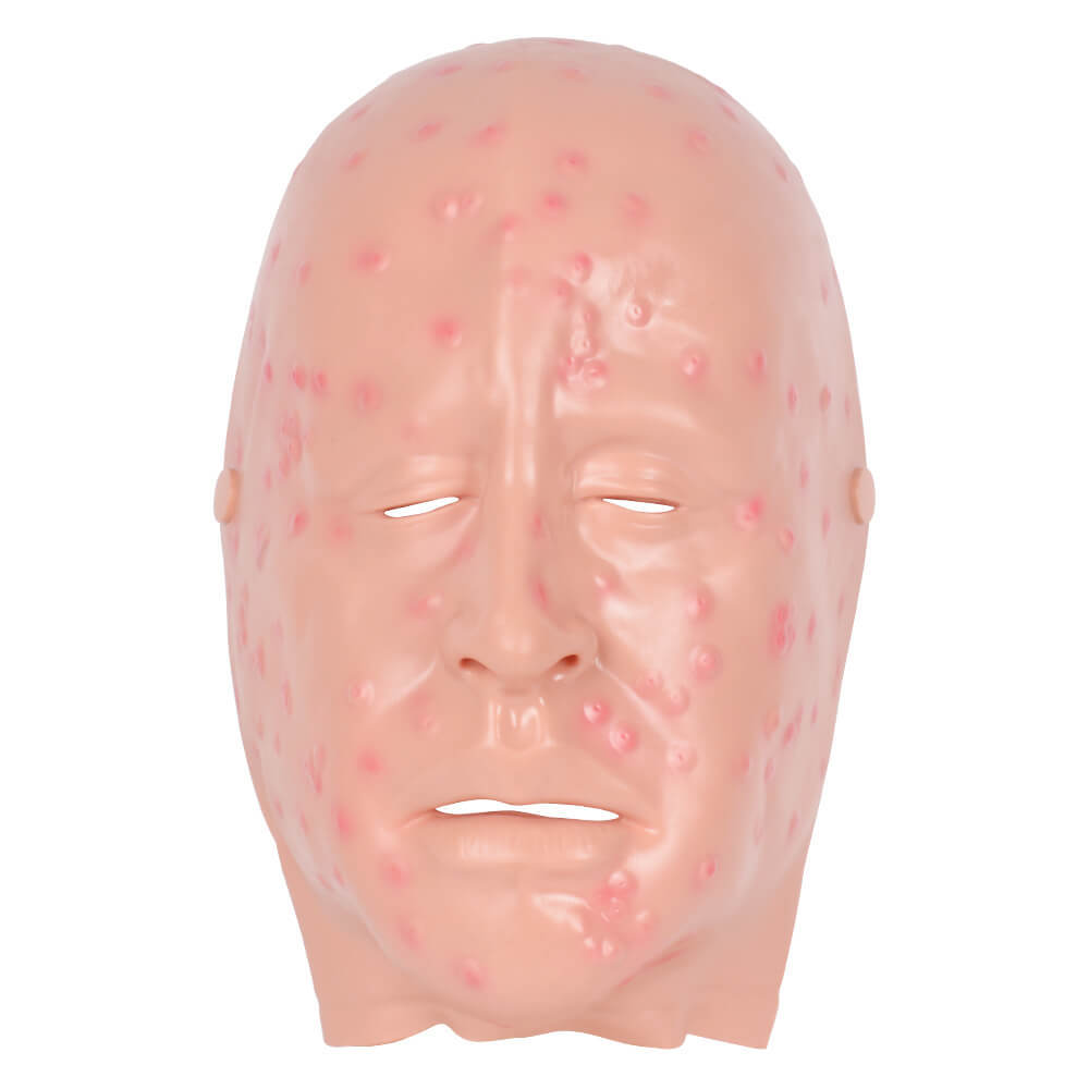 
Full-Face Wearable Facial Mild Smallpox Model