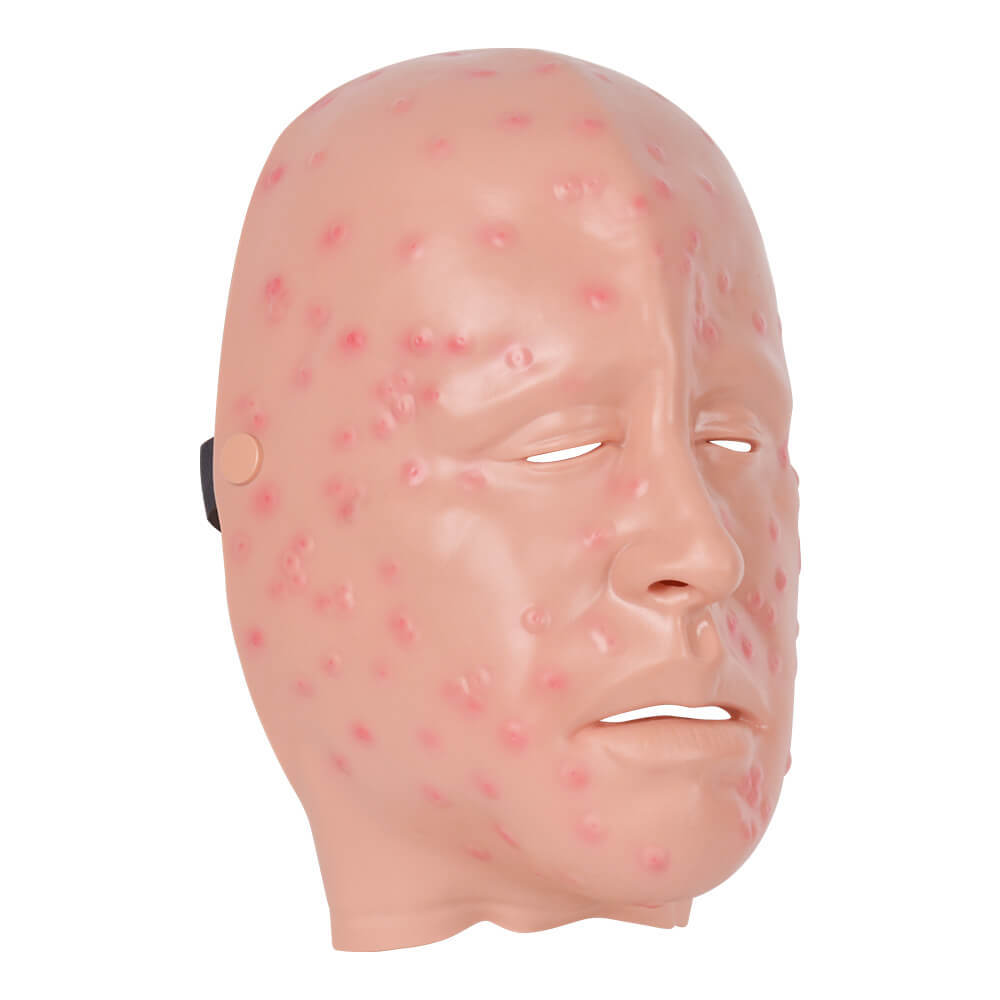 Wearable Facial Mild Smallpox Model