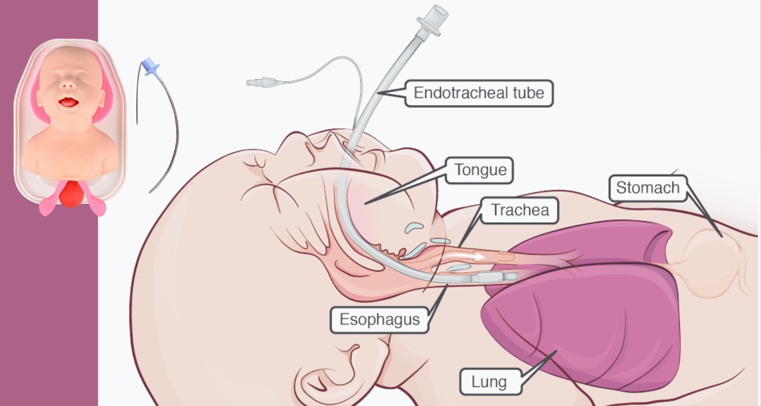 Indications for Neonatal Intubation