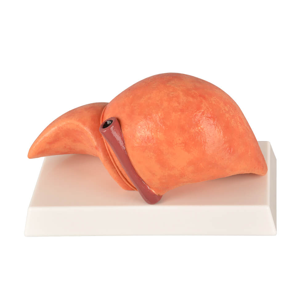 Non-Alcoholic Fatty Liver Disease (NAFLD) Model with Gall Bladder