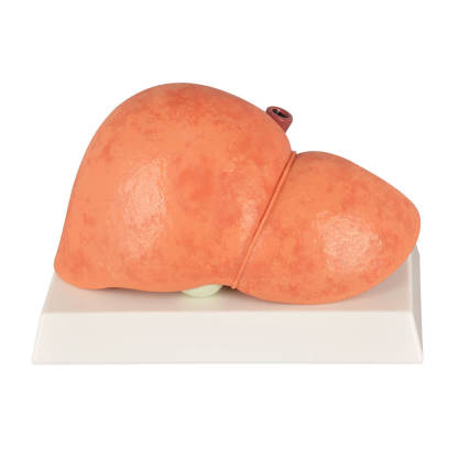 Normal & Fatty Liver Model Set with Gall Bladder