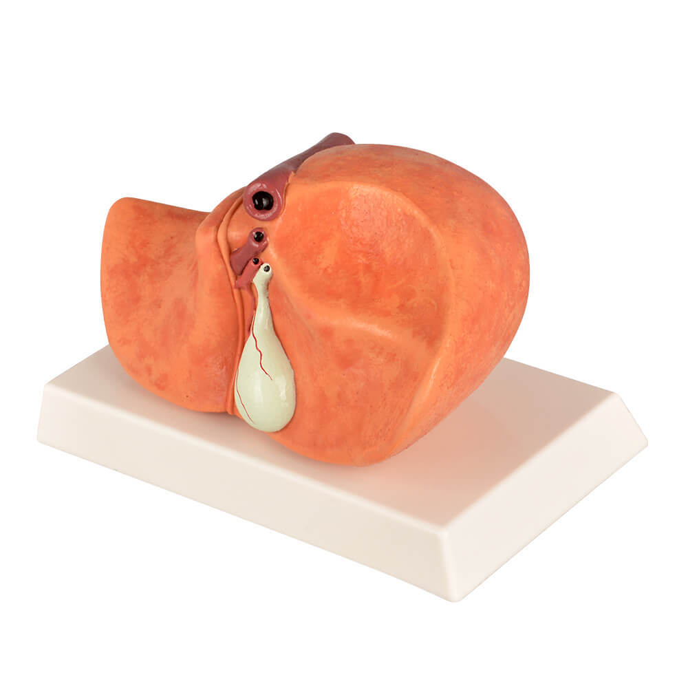 Non-Alcoholic Fatty Liver Disease (NAFLD) Model with Gall Bladder