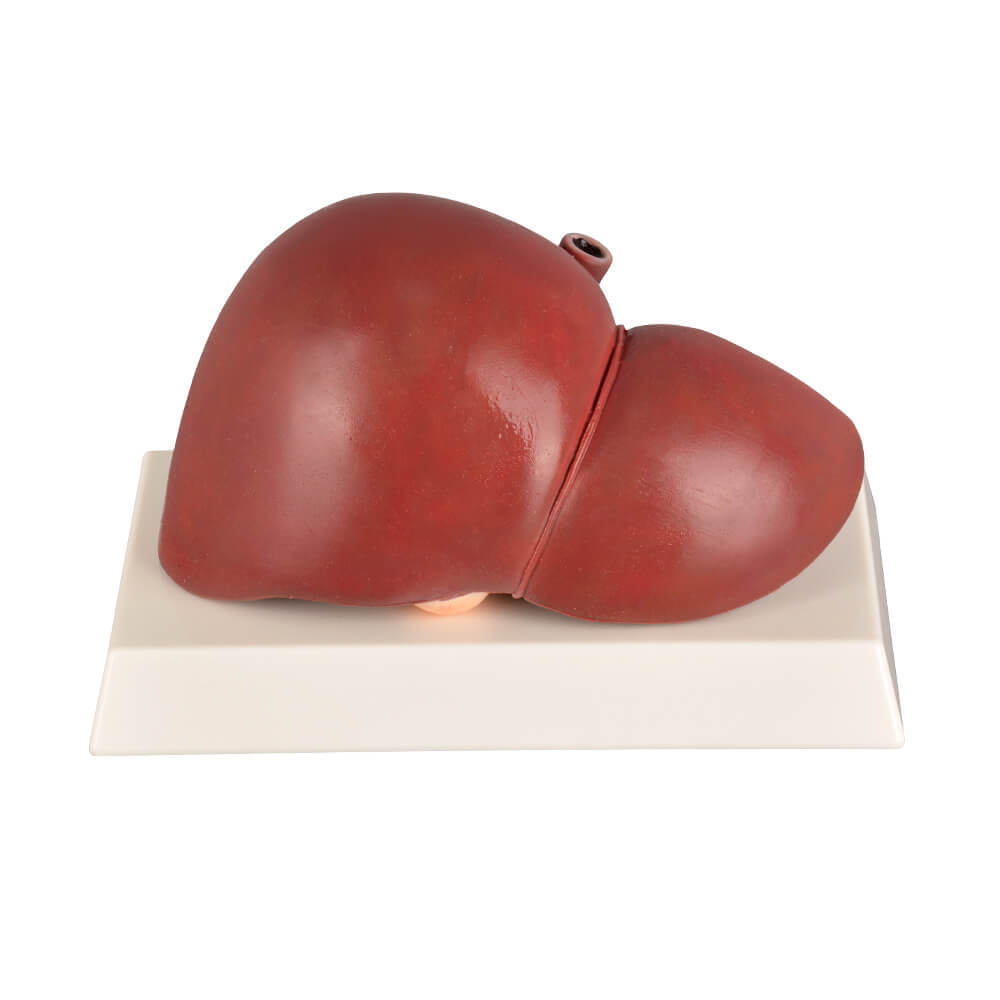 Normal & Fatty Liver Model Set with Gall Bladder