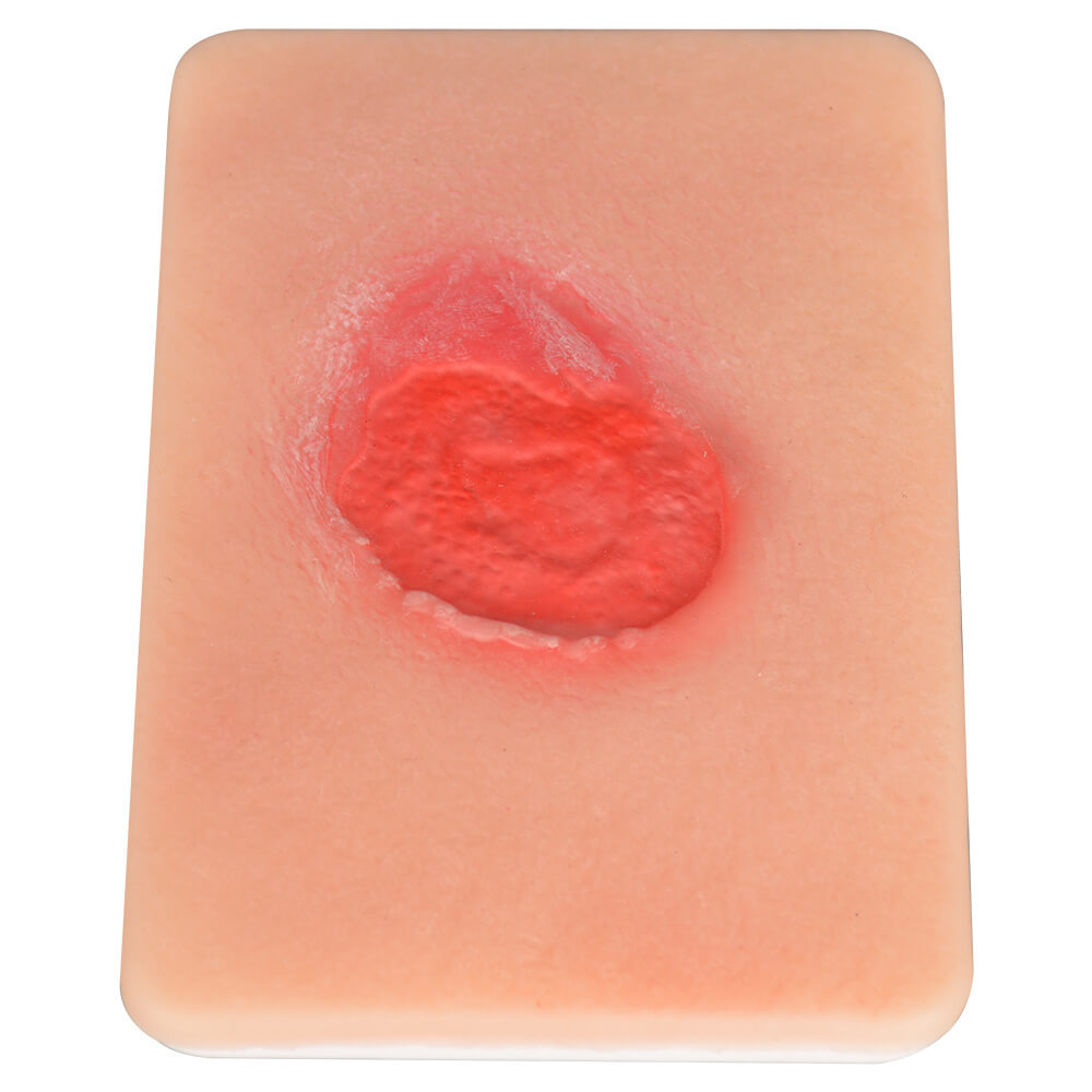 Pressure Ulcer Stage II Model