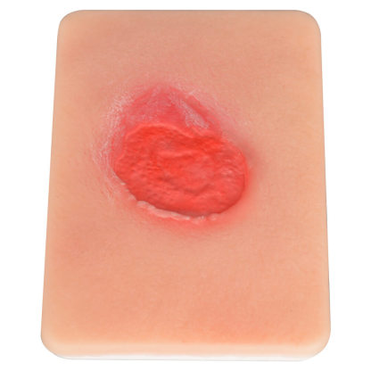 Pressure Ulcer Stage II Model