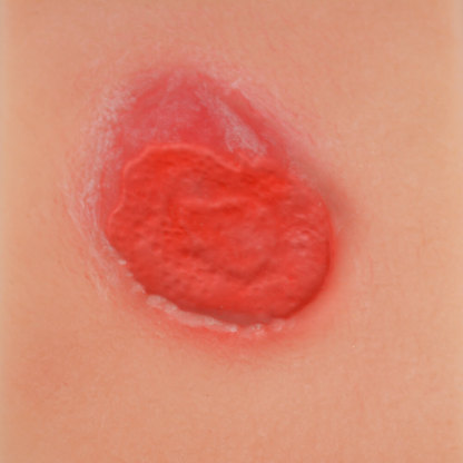 Pressure Ulcer Stage II Model