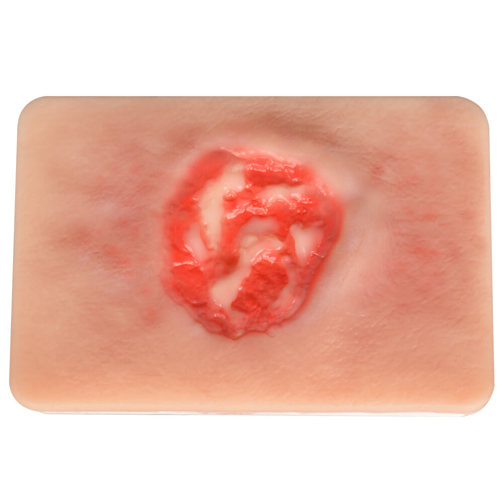 Pressure Ulcer Stage III Model