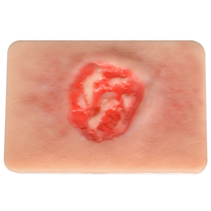 Pressure Ulcer Stage III Model