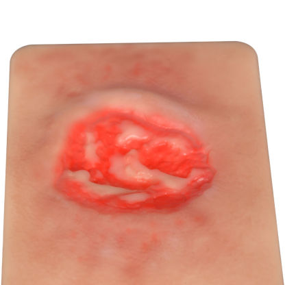 Pressure Ulcer Stage III Model