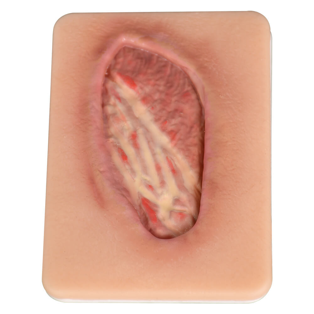 Stage IV Pressure Ulcer Model