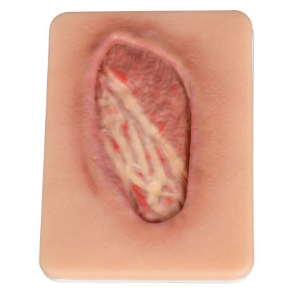 Stage IV Pressure Ulcer Model
