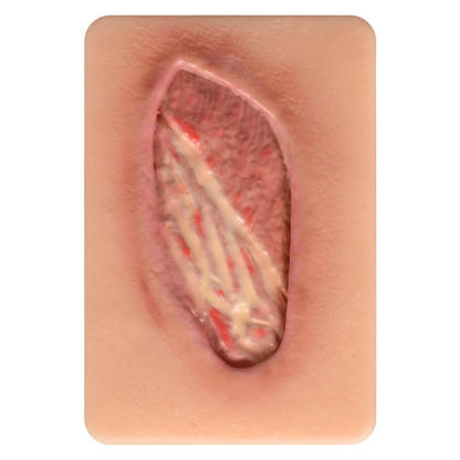 Stage IV Pressure Ulcer Model