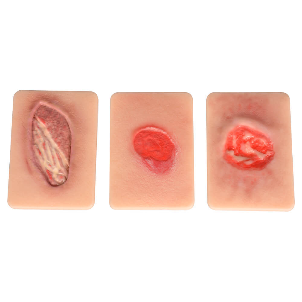 Pressure Ulcer Staging Model Set – Grades II, III, & IV Wound Simulation