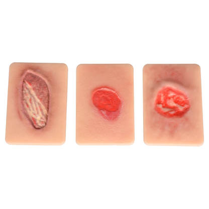 Pressure Ulcer Staging Model Set – Grades II, III, & IV Wound Simulation