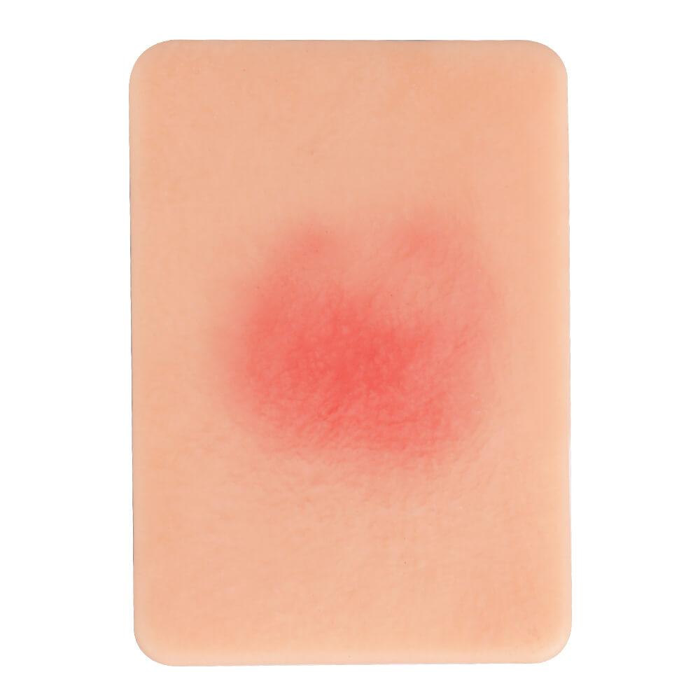 Pressure Injury Staging Comparison Model Set (Stages I–IV)