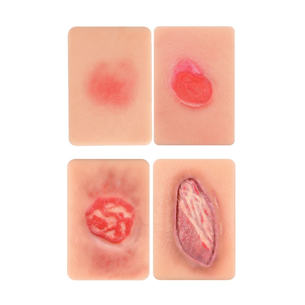 Pressure Injury Staging Comparison Model Set (Stages I–IV)