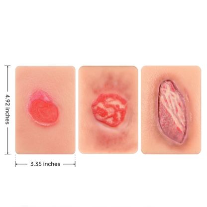 Pressure Injury Staging Comparison Model Set (Stages I–IV)
