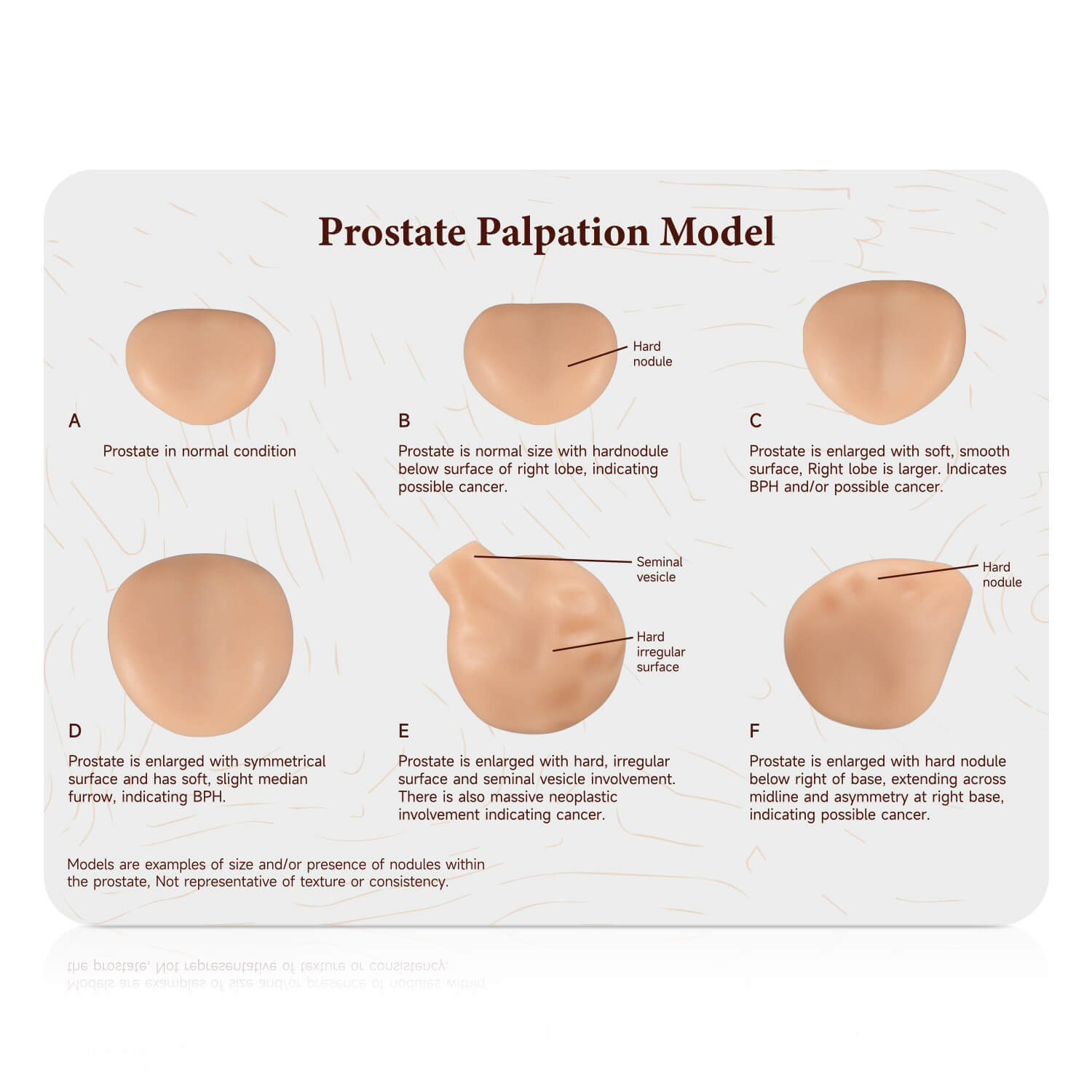 Prostate Examination Training Model with Normal & 5 Pathological Variants