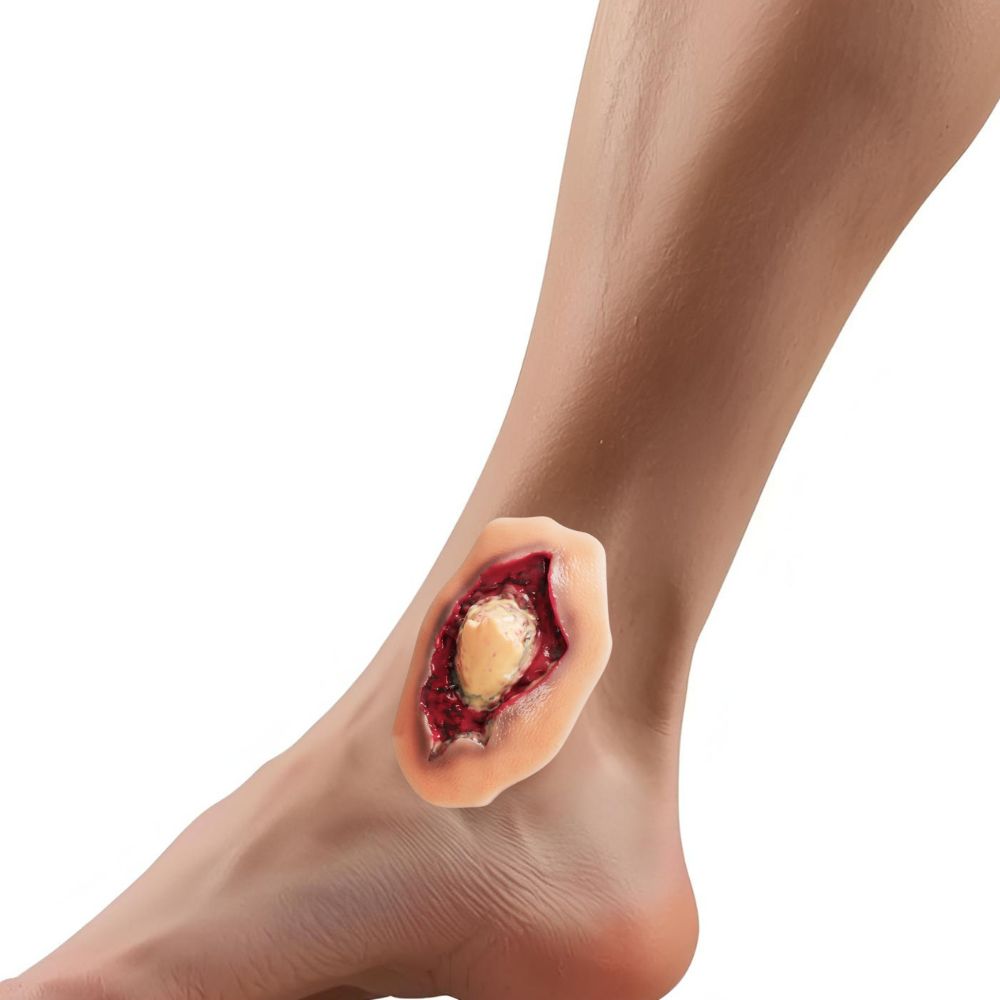 Adhesive Ankle Fracture Wound Moulage