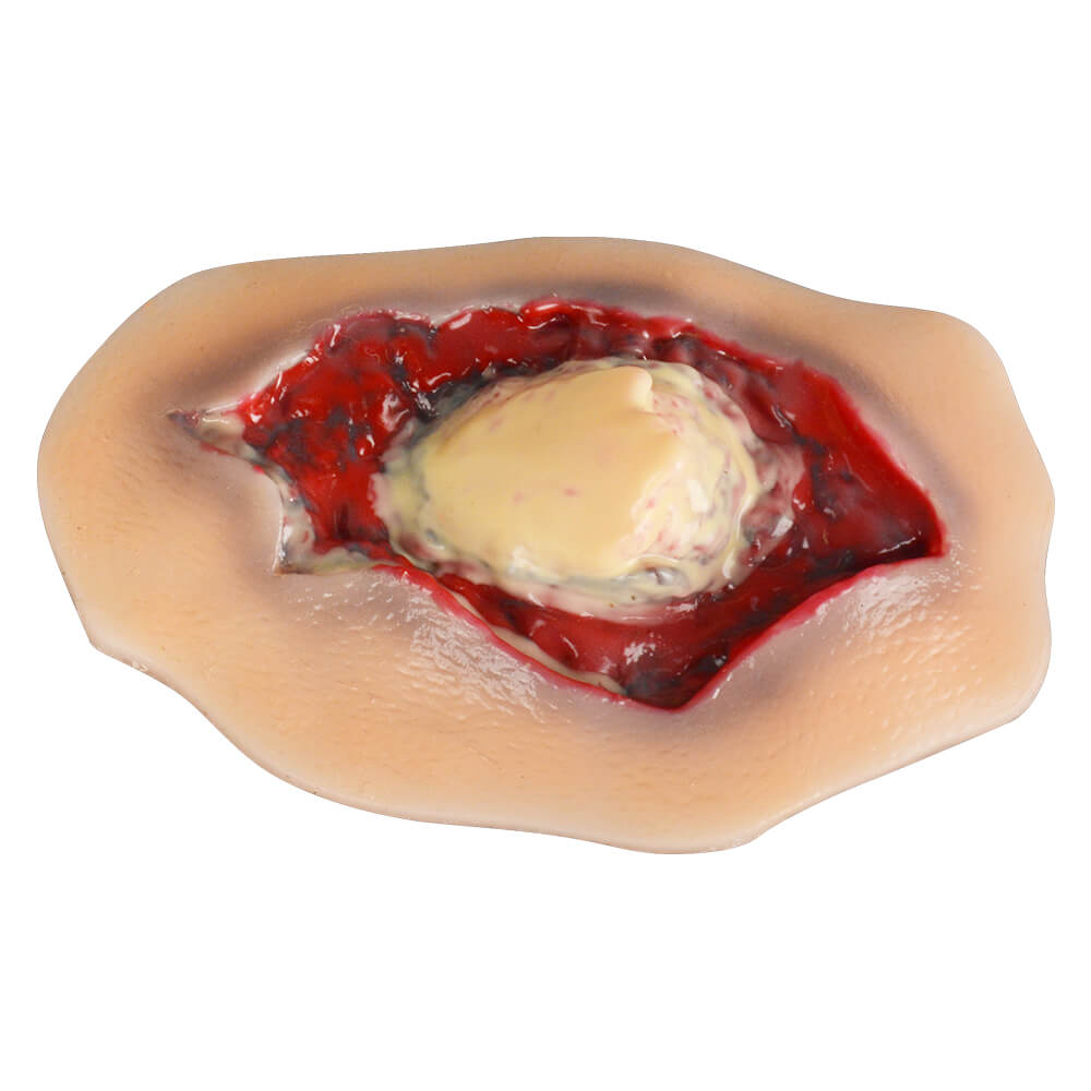 Self-Adhesive Silicone Ankle Fracture Wound Moulage