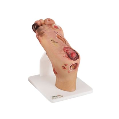 Full-Foot Diabetic Foot Ulcer Model - Mild & Severe Stages