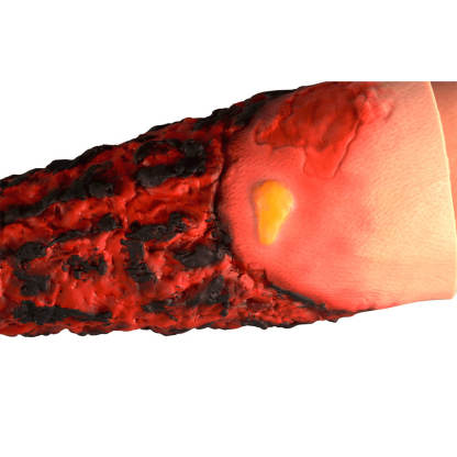 Severe Forearm Burn Simulation Sleeve