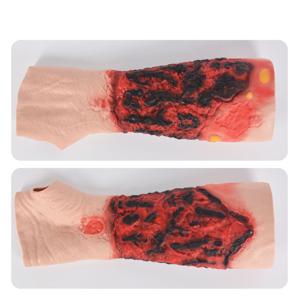 Severe Forearm Burn Simulation Sleeve