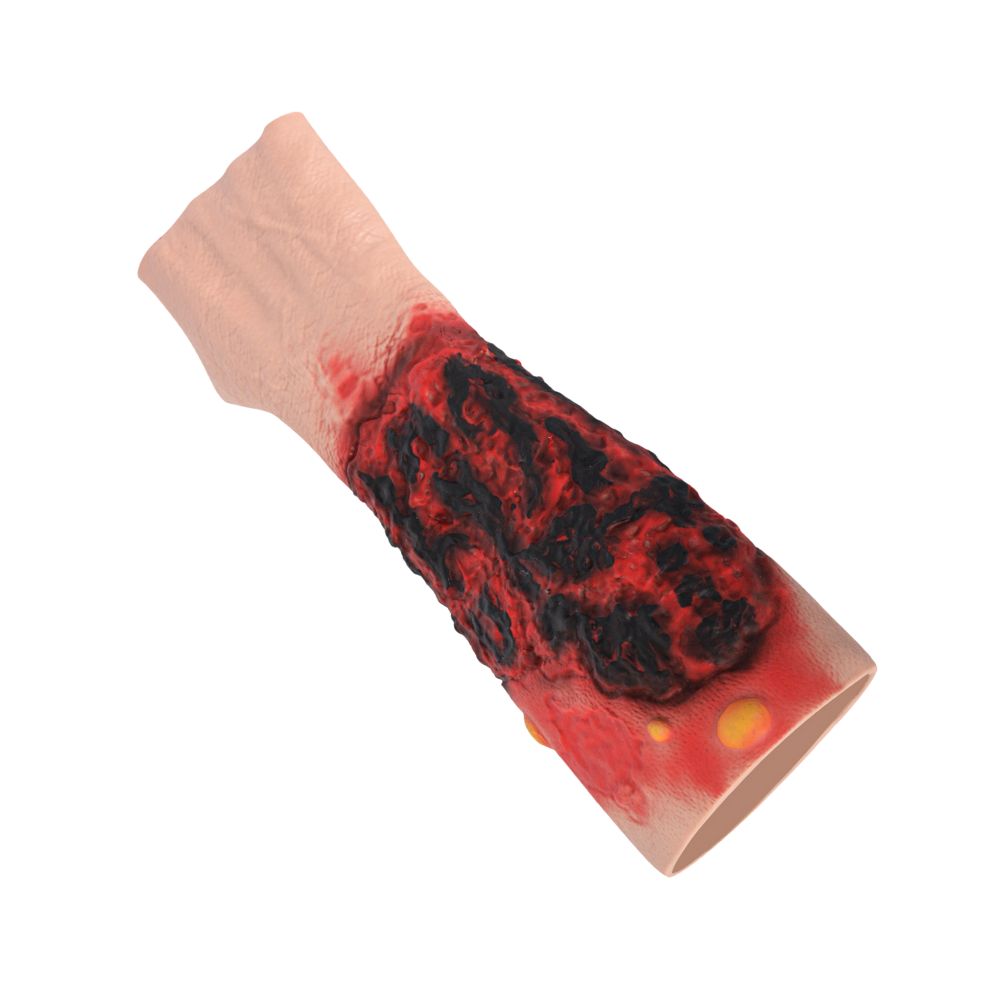 Severe Forearm Burn Simulation Sleeve