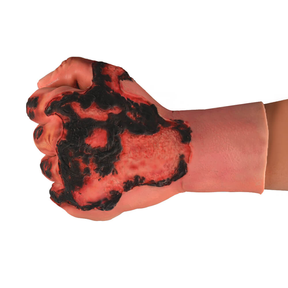 3rd Degree Hand Burn Simulation Glove
