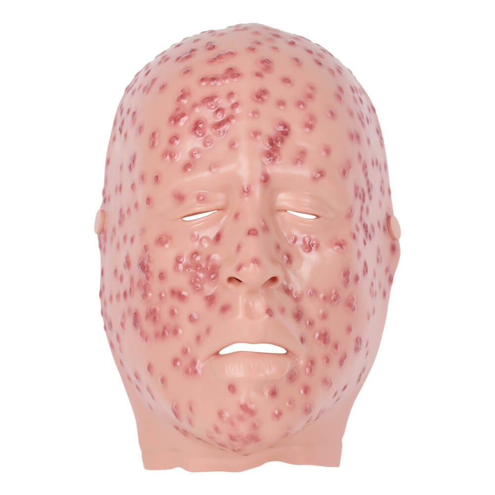 Severe Smallpox Facial Simulation Wound Training Mask
