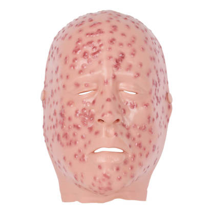 Severe Smallpox Facial Simulation Wound Training Mask