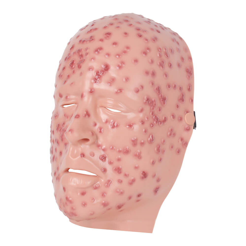 Wearable Facial Severe Smallpox Model