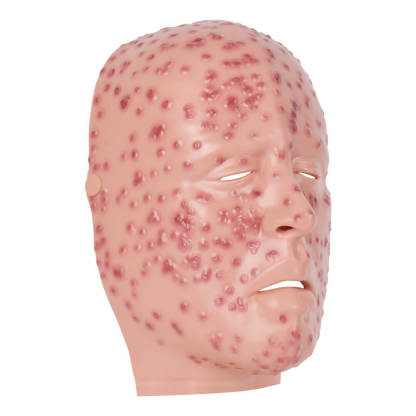 Severe Smallpox Facial Simulation Wound Training Mask