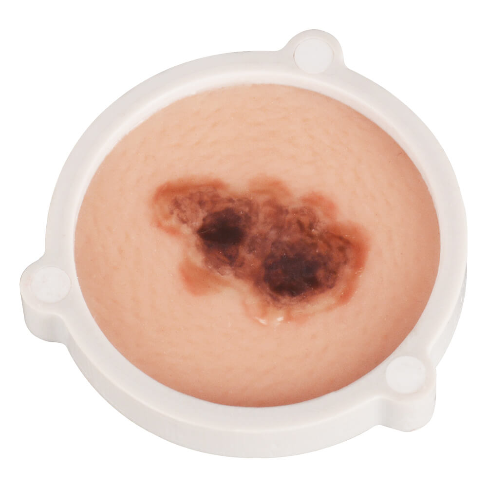 3-in-1 Magnetic Skin Cancer Model for Medical & Dermatology Education