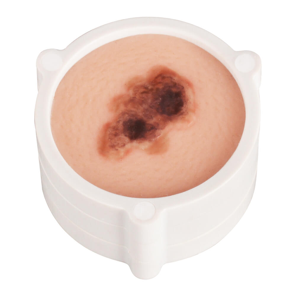 3-in-1 Magnetic Skin Cancer Model for Medical & Dermatology Education