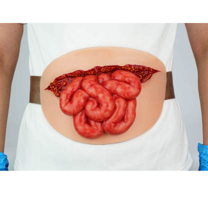 Wearable Abdominal Wound Small Bowel Evisceration 